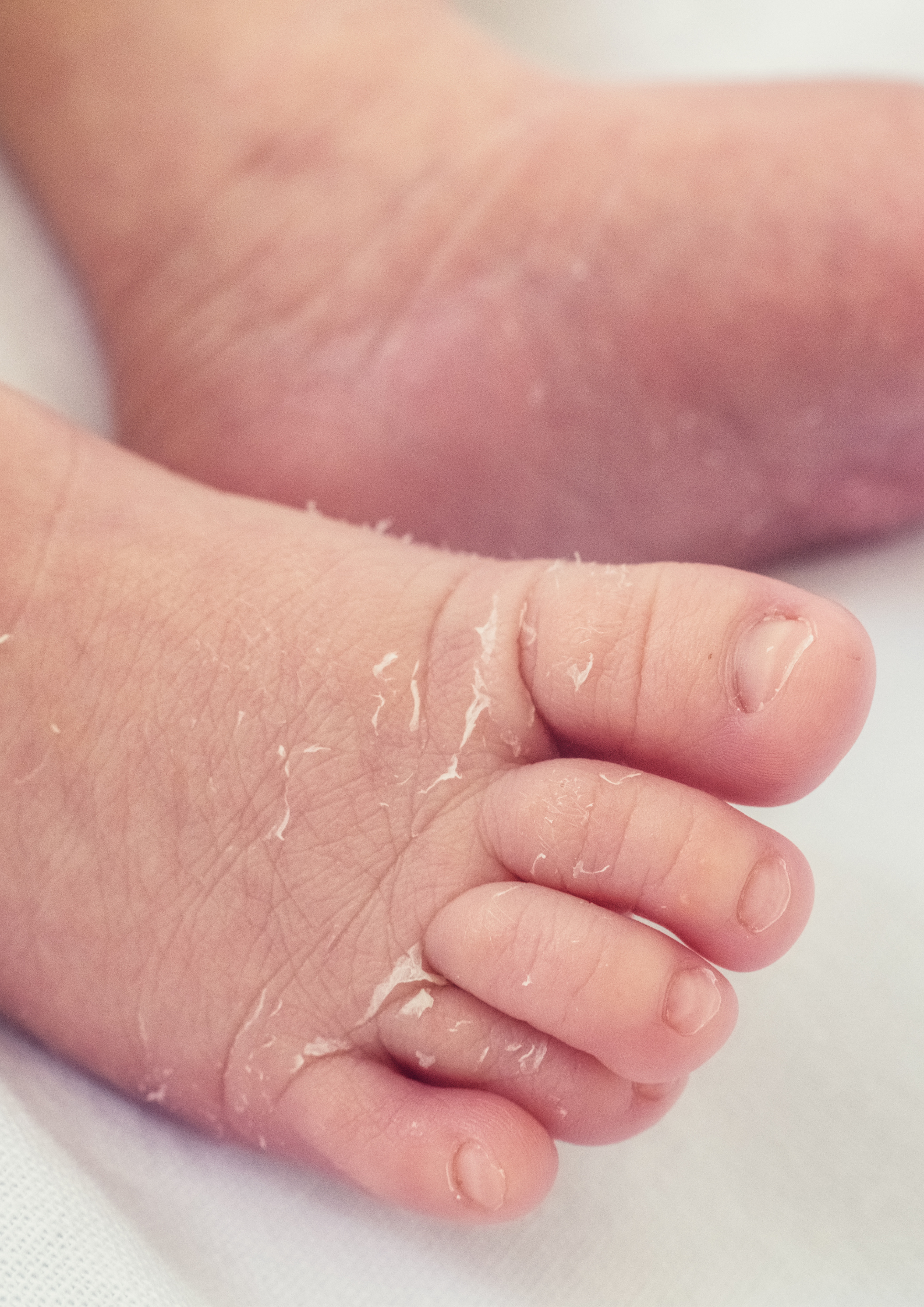 Dry skin in Babies