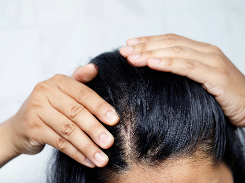 Hair Loss During Pregnancy: Causes, Remedies, and Reassurance