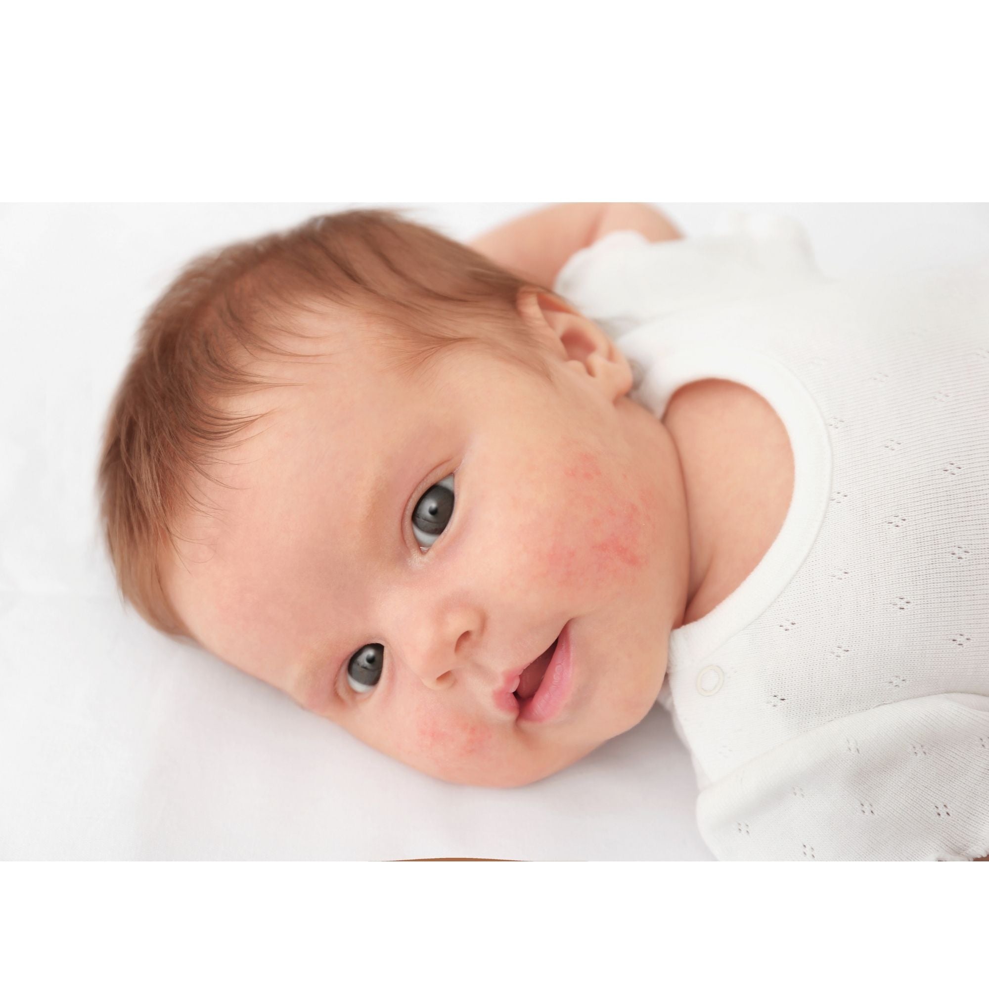 ECZEMA IN BABIES & CHILDREN